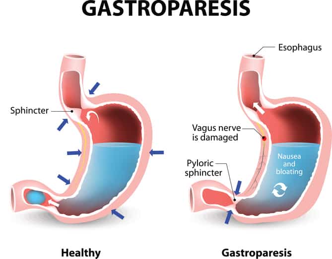 Effective Ways to Modify Your Gastroparesis Diet for Better Digestion in 2025